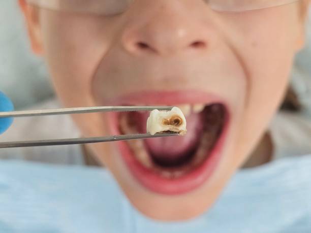 Best Broken or Chipped Tooth Repair in Hines, OR